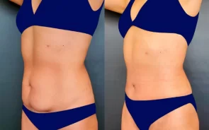 Resultados de abdominoplastia