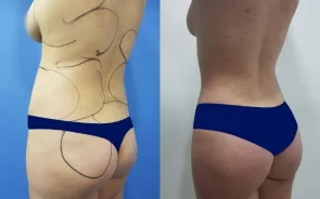 Antes y después de lipoescultura