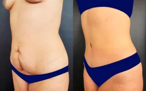 Antes y después de abdominoplastia