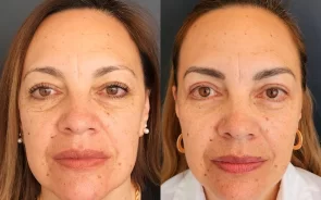 Antes y después de blefaroplastia