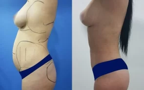 Antes y después de lipoescultura