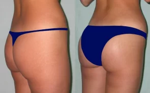 Cirugía de gluteoplastia