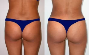 Gluteoplastia