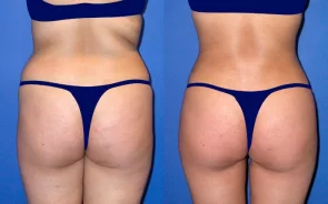 Antes y después de gluteoplastia