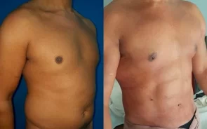 Resultados marcación abdominal en hombre