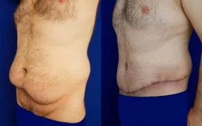 Resultados abdominoplastia en hombre