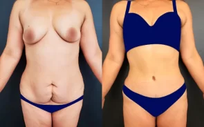 Resultados abdominoplastia en mujer