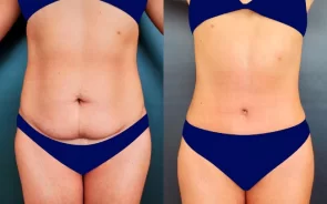 Resultados cirugía abdominoplastia