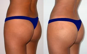 Resultados de la gluteoplastia