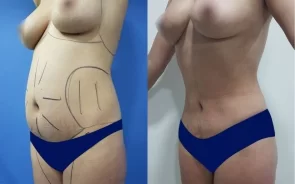 Resultados de lipoescultura