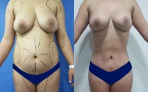 Resultados cirugía lipoescultura